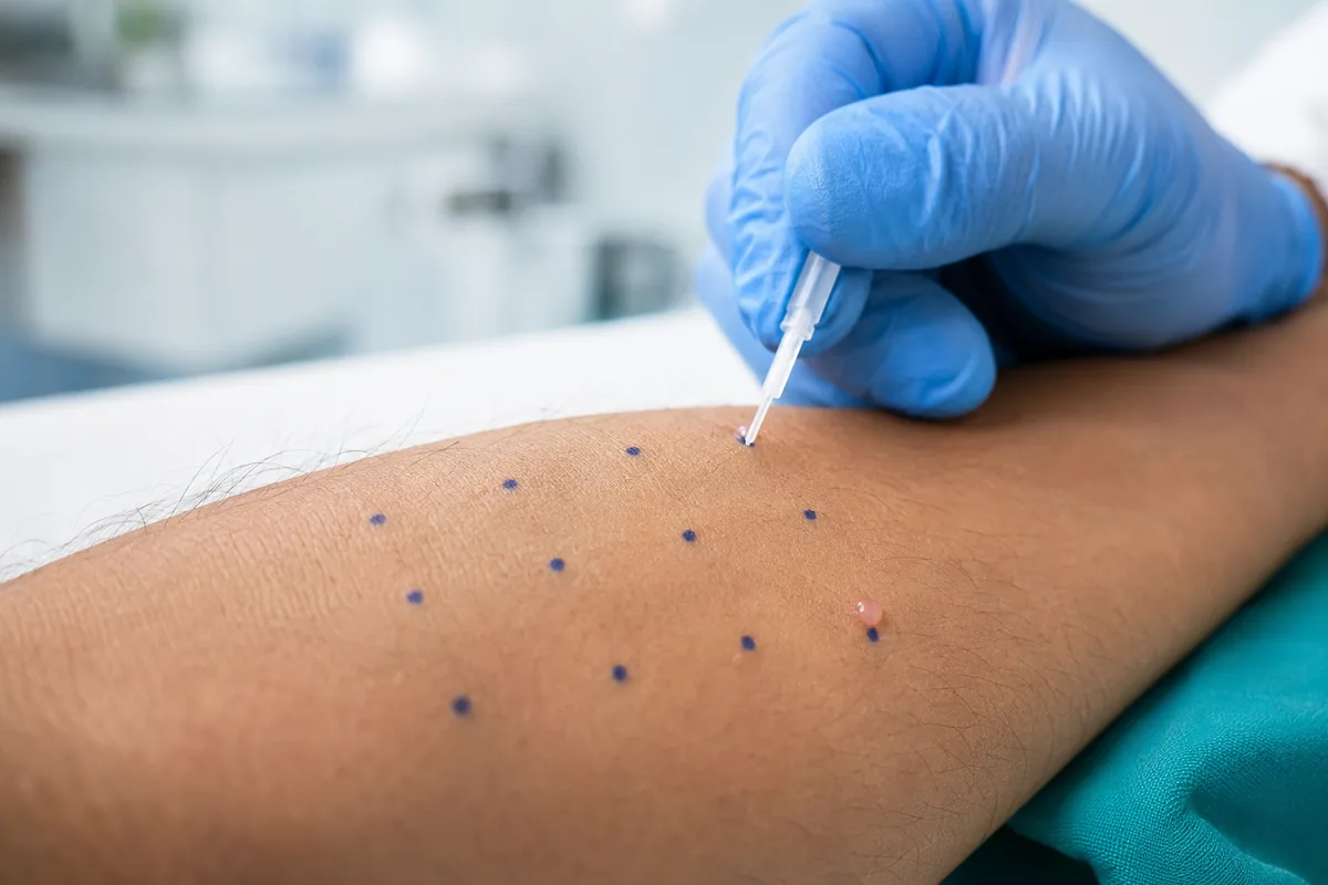 Skin prick allergy test being performed on a patient's forearm at Vista ENT Clinic, Sector 82A, Gurgaon